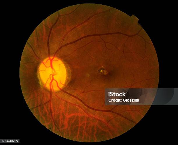 View Inside Human Eye Disorders Stock Photo - Download Image Now - Glaucoma, Fundus, Photography