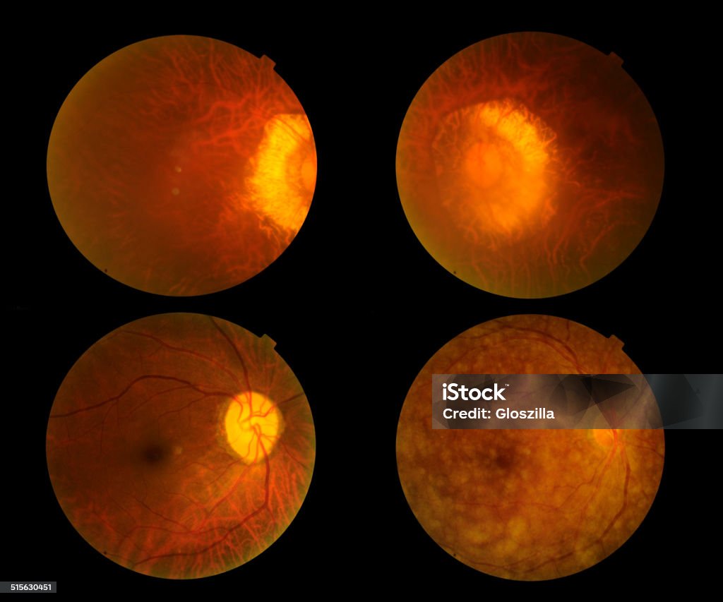 Inner Eye Problems View Inside Human Eye Disorders Stock Photo - Download Image Now ...