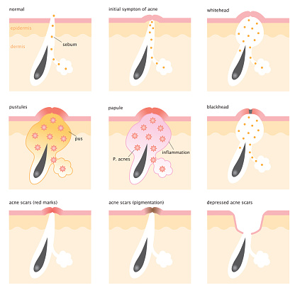How Acne Develops Acne Formation Process Stock Illustration - Download Image Now - Sebum ...