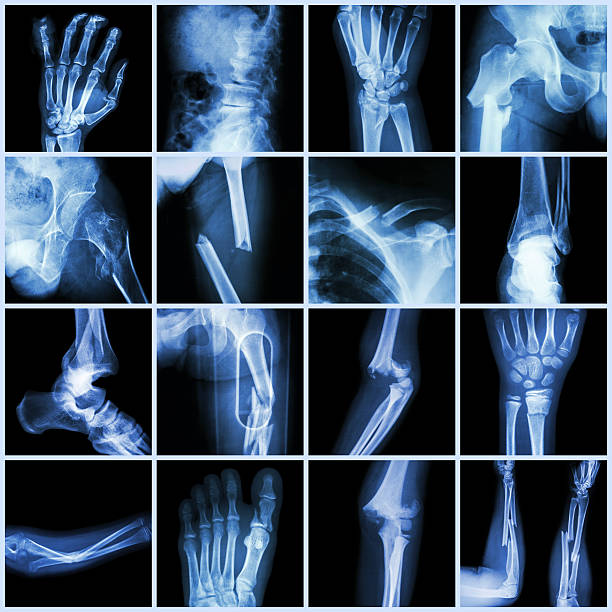 collection x-ray plusieurs os fracture - x ray x ray image shoulder human arm photos et images de collection