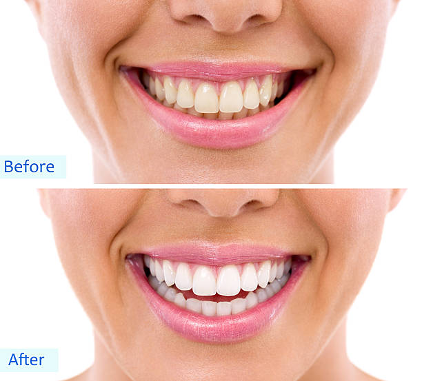 istock whitening - bleaching treatment ,woman teeth and smile, before a 515725931