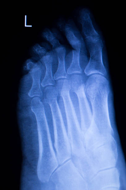 istock Foot and toes injury xray scan 515779552
