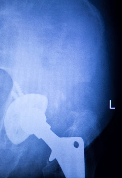 istock Hip replacement xray orthopedic medical scan 515779858