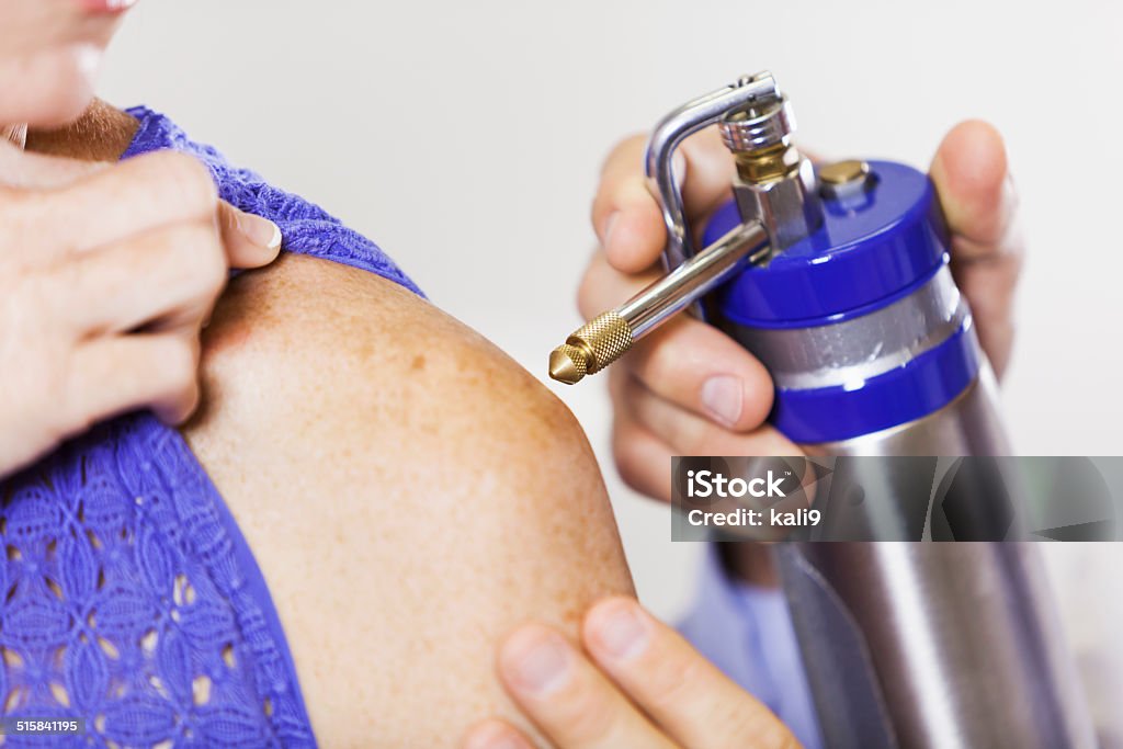 Skin cancer treatment Dermatologist using cryotherapy to remove skin lesion from patient. Cryotherapy Stock Photo