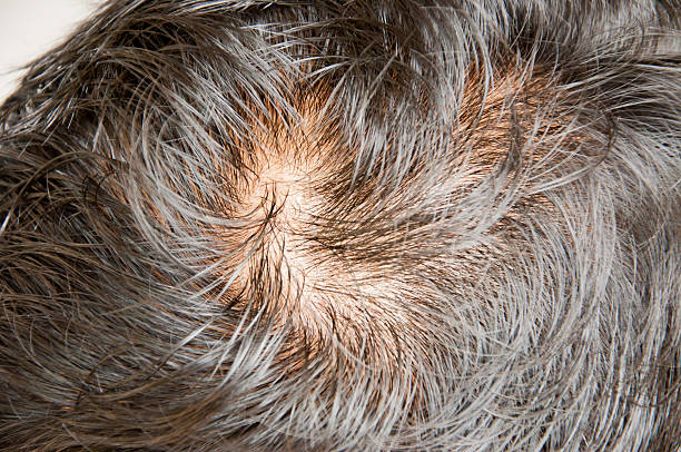 istock Human alopecia or hair loss problem and grizzly 515923371