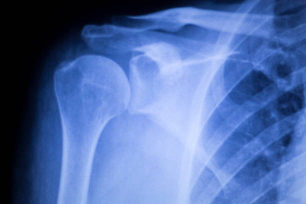 istock Spine vertebra ribs back injury xray scan 516047968