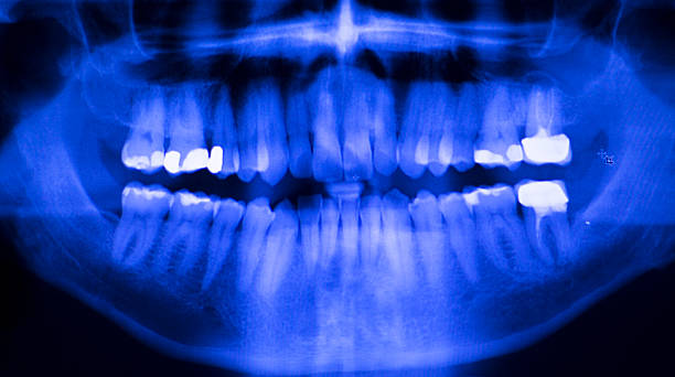 istock Dental teeth filling dentists xray scan 516063778