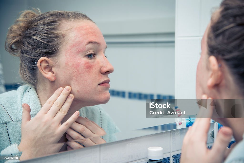 Oh my god, what is that? Woman with allergic reaction looking herself in the mirror. Eczema Stock Photo