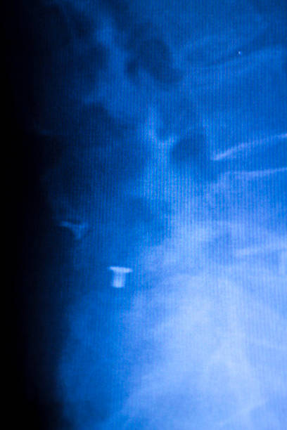 istock Spine orthopedic implant xray scan 516067212