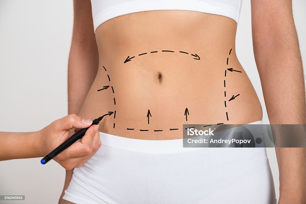 Person Hand Drawing Lines On A Woman's Abdomen Person Hand Drawing Lines On A Woman's Abdomen As Marks For Abdominal Cellulite Correction Liposuction Stock Photo