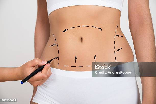 Person Hand Drawing Lines On A Womans Abdomen Stock Photo - Download Image Now - Liposuction, Plastic Surgery, Surgery