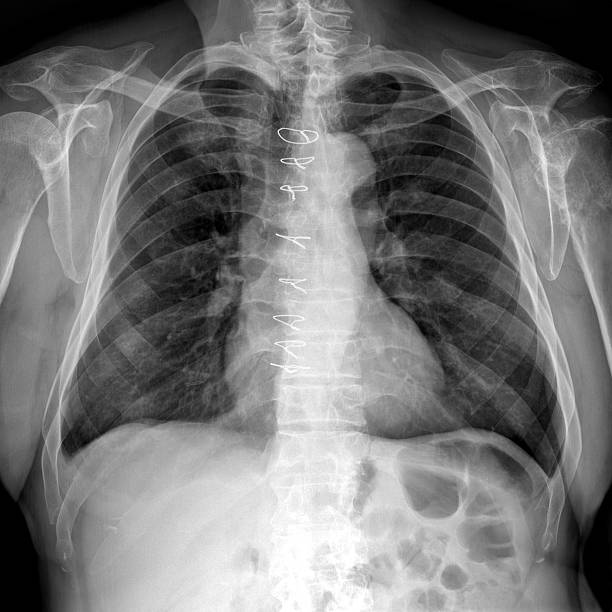 istock Osteosynthesis after cardiac surgery 516541144