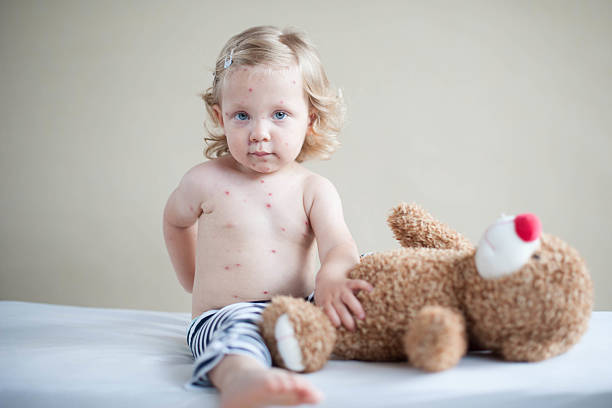 멀미용 여자아이 아래쪽으로 침대, 테디-베어 - chickenpox skin condition baby illness 뉴스 사진 이미지