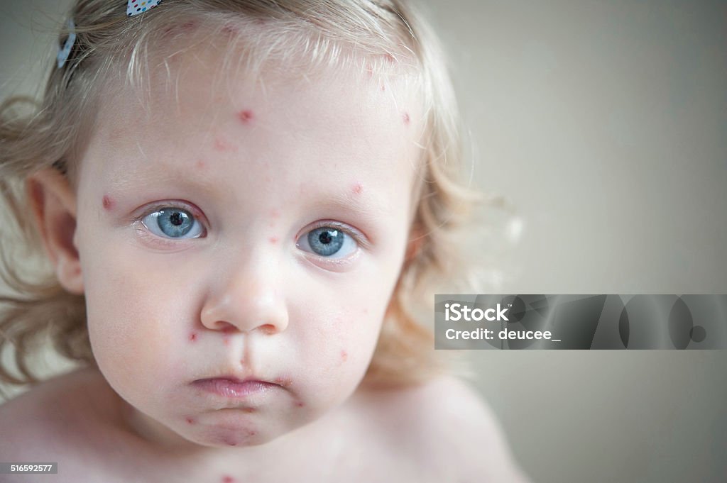 Girl with chickenpox Child Stock Photo