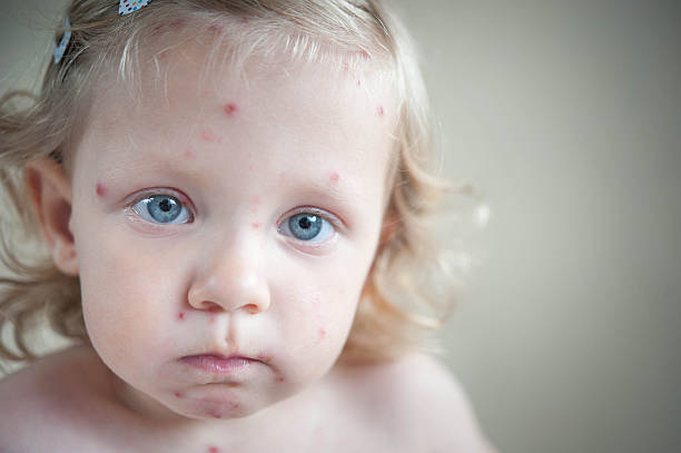 Girl with chickenpox stock photo