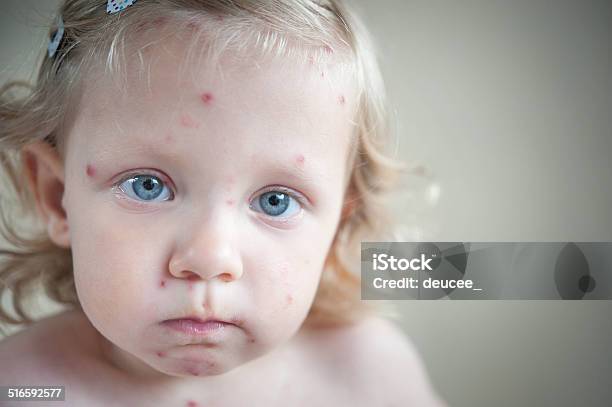 Girl With Chickenpox Stock Photo - Download Image Now - Child, Chickenpox, Girls