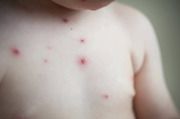 Chickenpox - disease stock photo