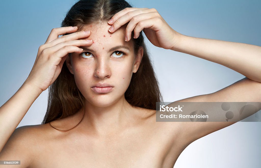 Ugly problem skin girl. Woman skin care concept photos of Latina girl on blue background Chickenpox Stock Photo