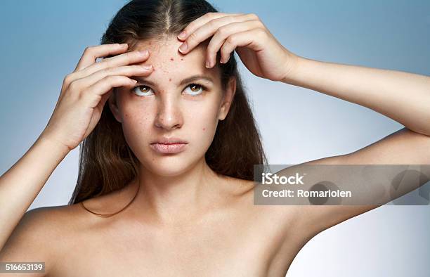 Ugly Problem Skin Girl Woman Skin Care Concept Stock Photo - Download Image Now - Chickenpox, Adult, Beauty Spa