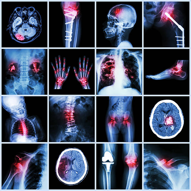 conjunto de raio-x de várias parte do homem, várias doenças, ortopédico - cat scan pelvis hip human spine - fotografias e filmes do acervo