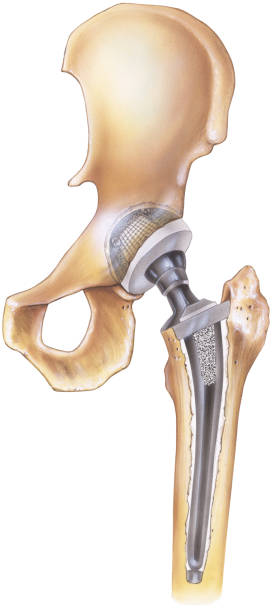 Hip - Total Replacement illustration of a total hip replacement. The femoral stem and the plastic socket of the prosthesis are shown cemented in place. hip replacement stock illustrations