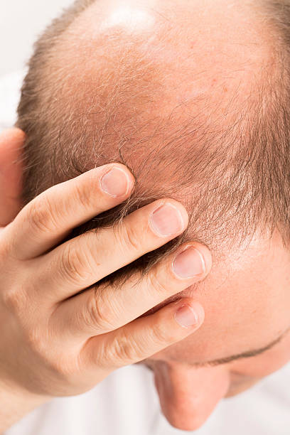 istock Baldness Alopecia man hair loss 516795130