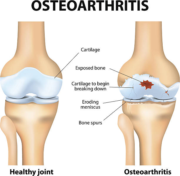 ilustrações, clipart, desenhos animados e ícones de osteoartrite ou artrite - tíbia perna humana