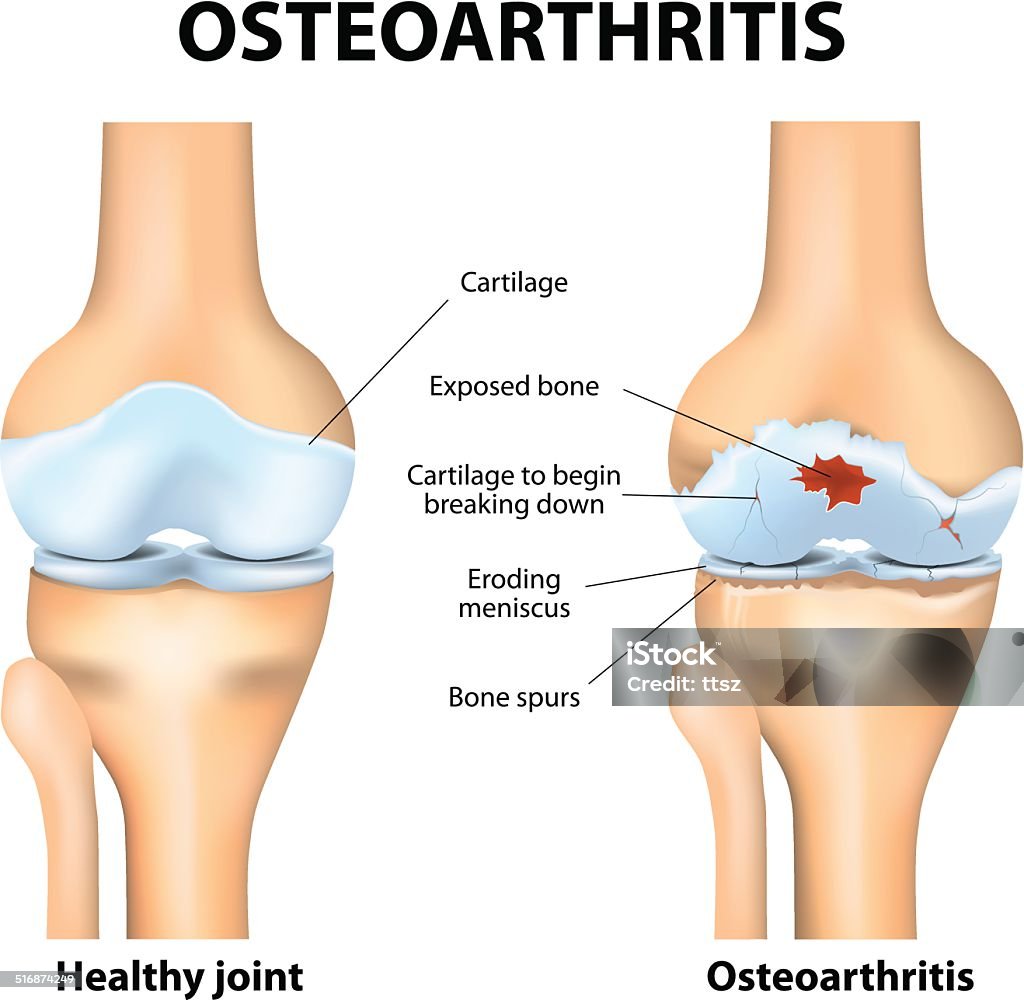 Osteoarthritis or arthritis Osteoarthritis. Arthritis or pain within a joint. degenerative joint disease. Cartilage becomes worn. This results in inflammation, swelling, and pain in the joint. Osteoarthritis stock vector