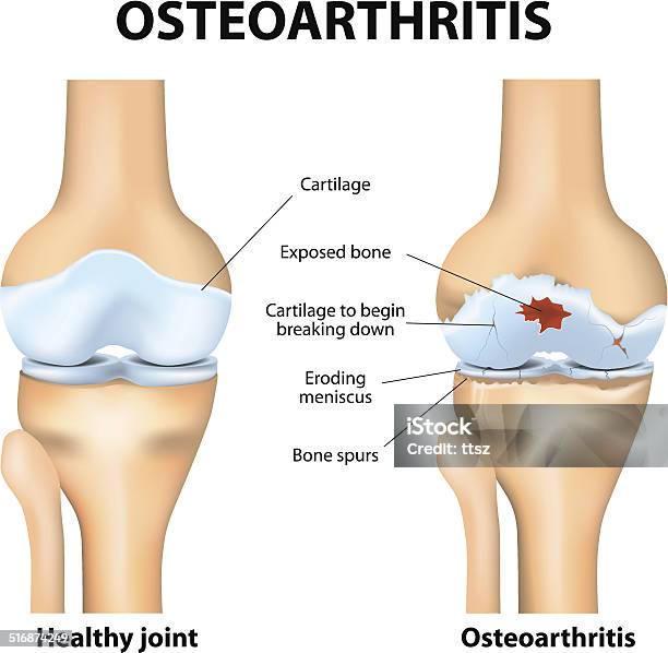 Osteoarthritis Or Arthritis Stock Illustration - Download Image Now - Osteoarthritis, Knee, Arthritis