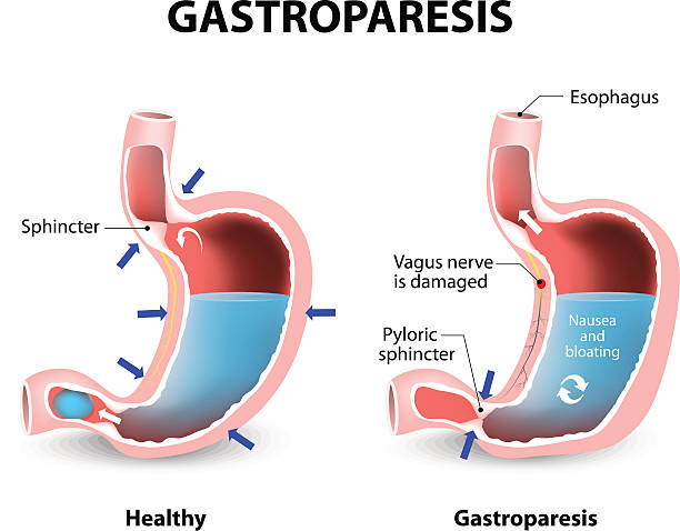 Gastroparesis Gastroparesis or delayed gastric emptying. Visual comparison of healthy gastric and stomach with Gastroparesis. sphincter stock illustrations