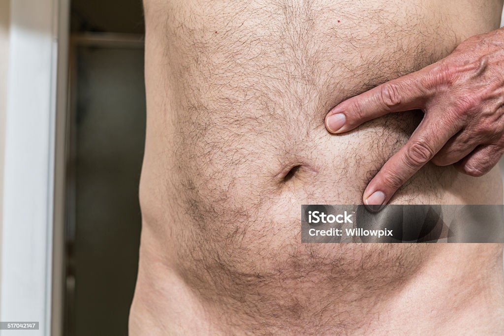 Man Pointing To Umbilical Hernia Belly Button Scar About a year after umbilical hernia surgery, a senior man is pointing and spreading his fingers  to show his fully healed navel scar. Belly Button Stock Photo