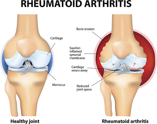 Normal Joint and Rheumatoid Arthritis Rheumatoid Arthritis or RA is an inflammatory type of arthritis that usually affects knees. Rheumatoid arthritis of the knee the auto immune disease. The body's immune system mistakenly attacks healthy tissue. colour enhanced stock illustrations