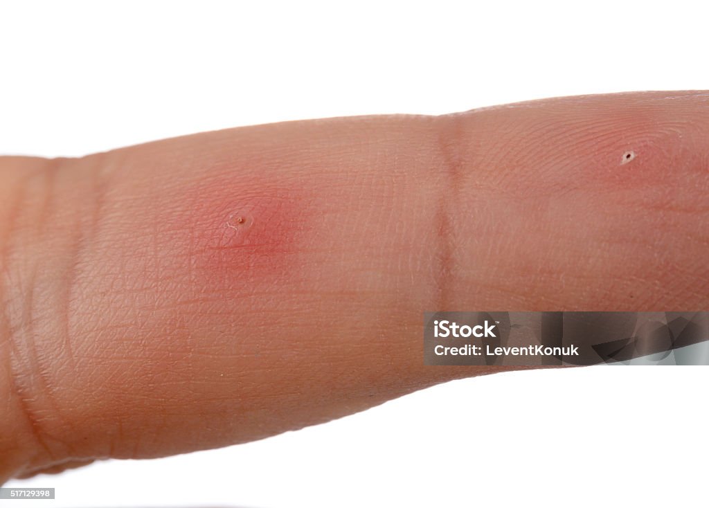 Splitter in Finger Nahaufnahme - Lizenzfrei Eine Person Stock-Foto