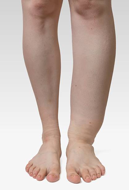 Leg of diseased patient who suffers from Edema. Leg of diseased patient who suffers from Edema. human leg stock pictures, royalty-free photos & images