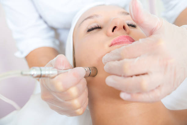 Microdermabrasion treatment Young woman receiving facial microdermabrasion treatment microdermabrasion stock pictures, royalty-free photos & images