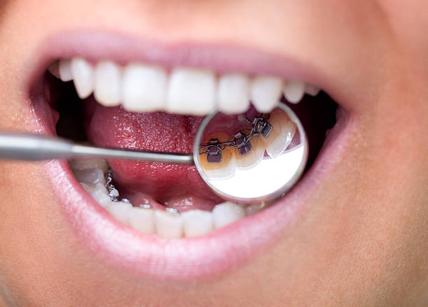 espejo dental mostrando bilingüe frenillos - lingual fotografías e imágenes de stock