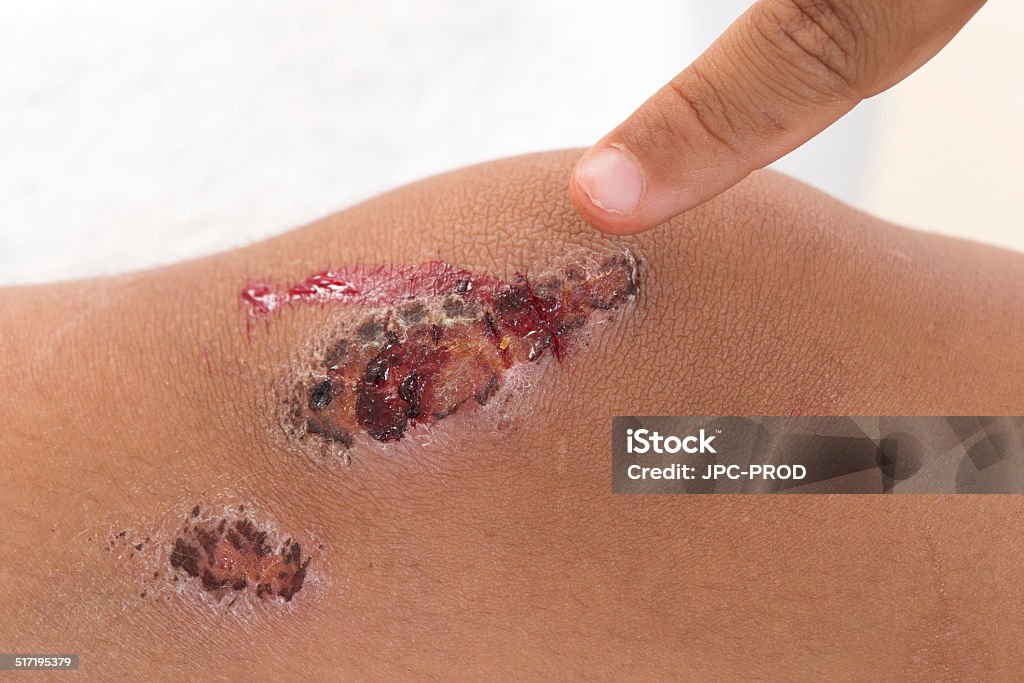 craped Knee Little Boy with a Scraped Knee Child Stock Photo