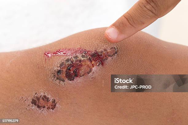 Craped Knee Stock Photo - Download Image Now - Child, Blood, Boys