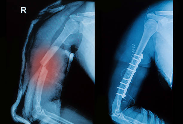 рентгеновское изображение borken кость руки показать до и после операции - humerus стоковые фото и изображения