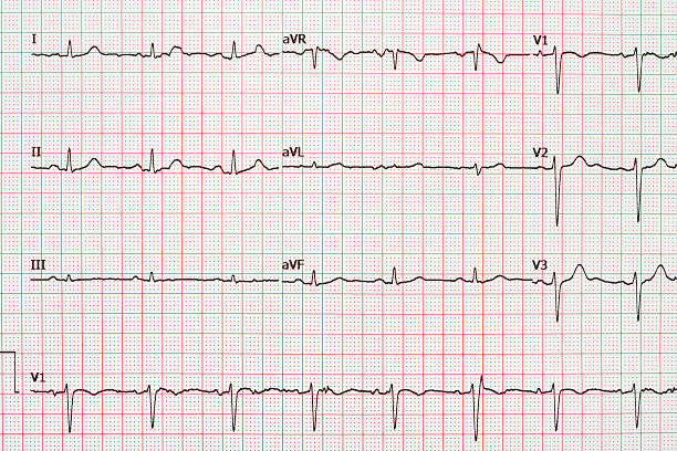 istock Extrasystole On 12 Lead Electrocardiogram Paper 517277464