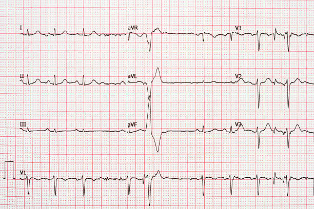 istock Extrasystole On 12 Lead Electrocardiogram Paper 517277572