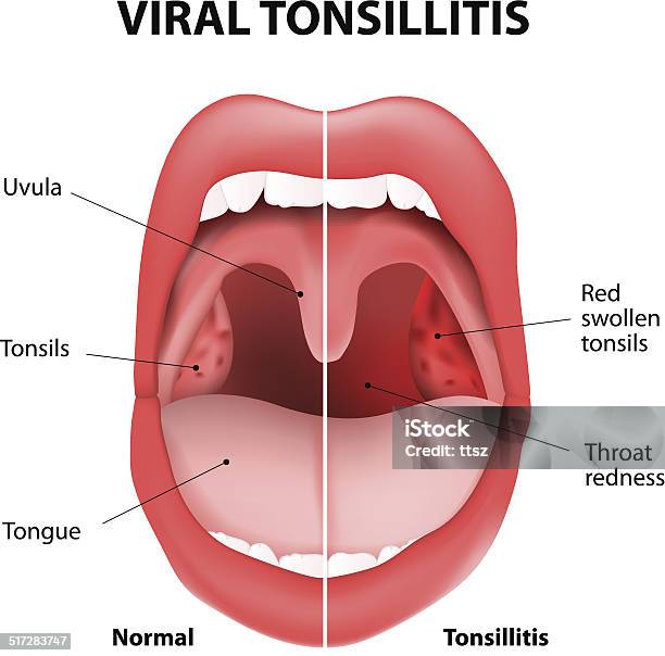 Ilustración de Amigdalitis Viral y más Vectores Libres de Derechos de Amigdalitis - Amigdalitis, Anginas, Asistencia sanitaria y medicina