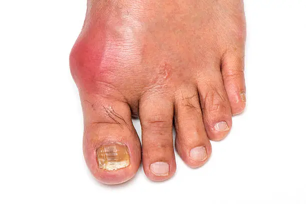 Foot infected with Gout and Fungus Toenail