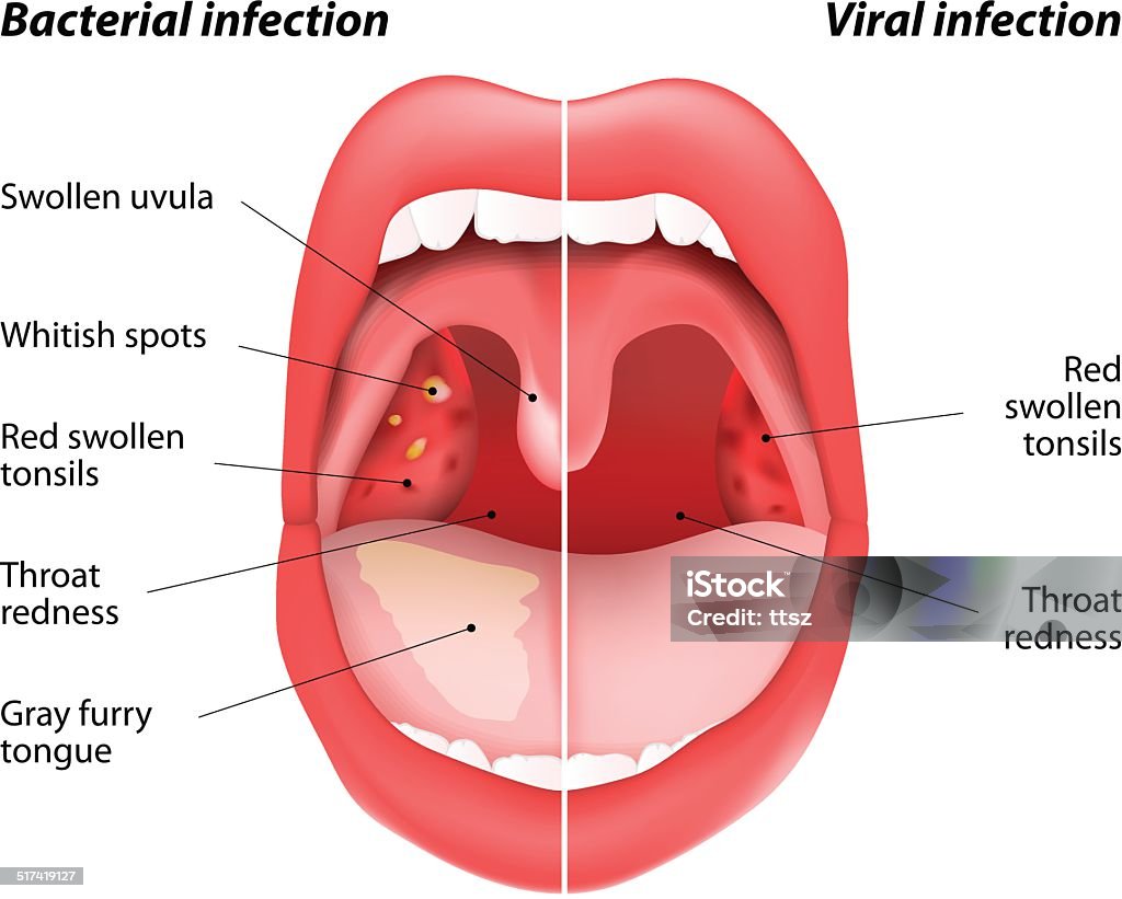 Las diferencias entre las infecciones virales y - arte vectorial de Amigdalitis libre de derechos