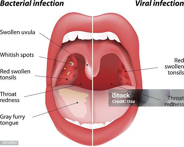 Ilustración de Las Diferencias Entre Las Infecciones Virales Y y más Vectores Libres de Derechos de Amigdalitis - Amigdalitis, Anginas, Virus
