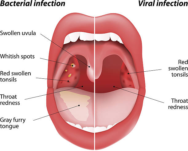 차이점을 바이러스 및 박테리아 감염 - pharyngitis stock illustrations
