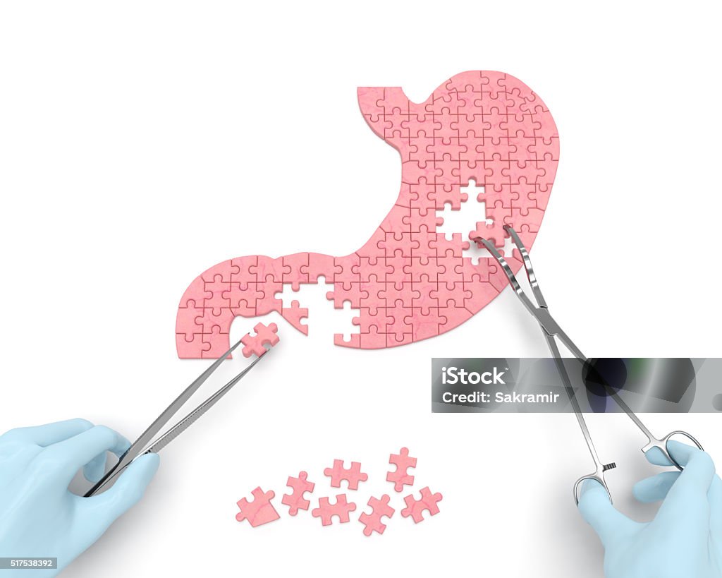 Bauch Chirurgie Betrieb (Medizin puzzle-Konzept - Lizenzfrei Magen Stock-Foto