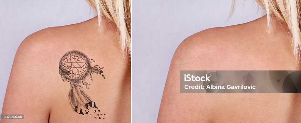 Laser Tattoo Removal Before And After Stock Photo - Download Image Now -  Tattoo, Removing, Back - iStock