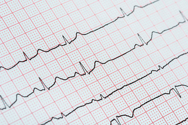 istock Sinus Heart Rhythm On Electrocardiogram Record Paper Showing Normal Heart 517603752