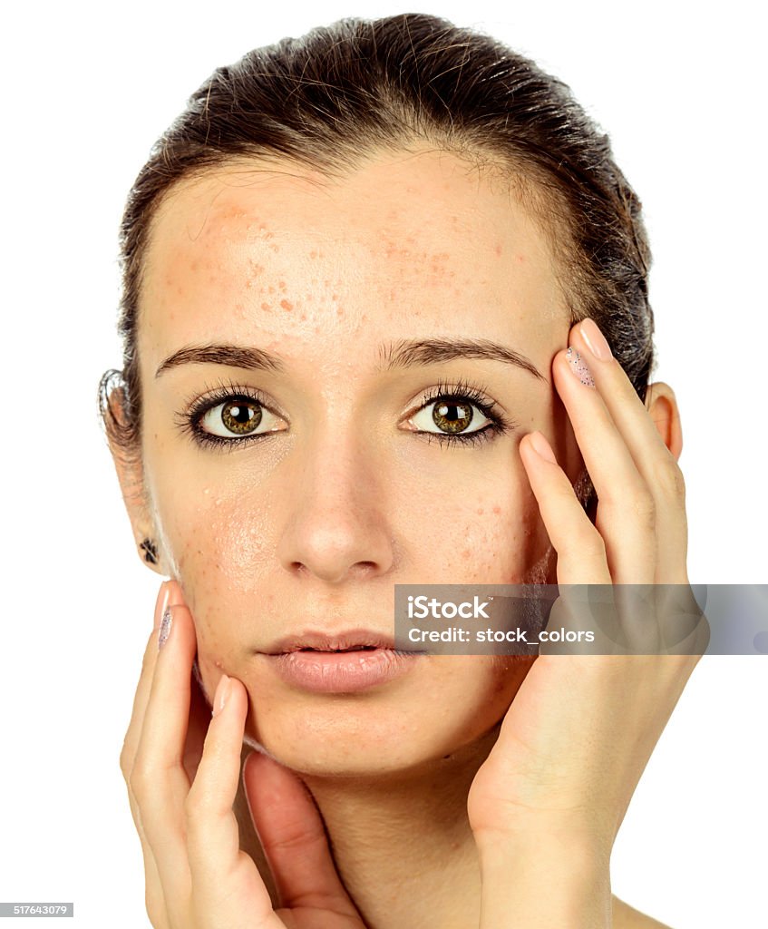 teenager problems acneic woman portrait touching face. Acne Stock Photo
